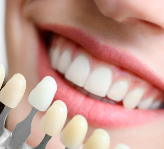 Fundas y carillas dentales