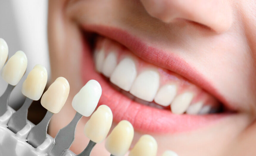 Fundas y carillas dentales