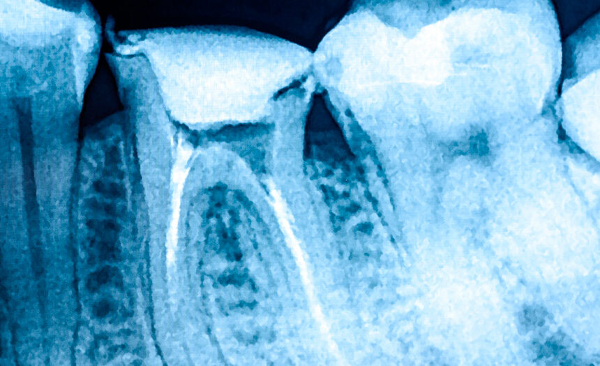 Endodoncista en Terrassa