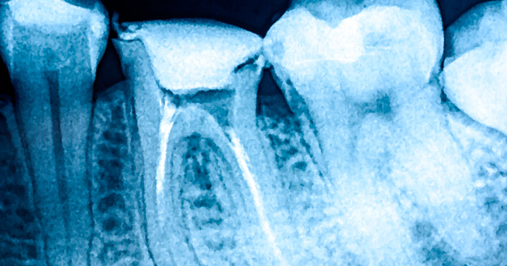 Endodoncista en Terrassa