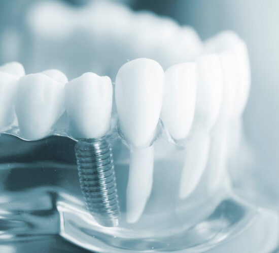 Implantes dentales en Terrassa