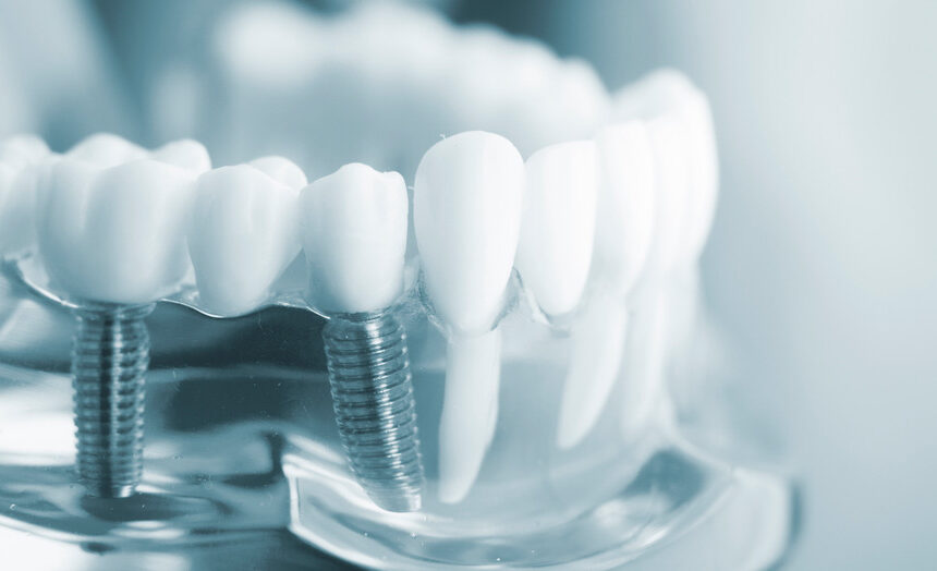 Implantes dentales en Terrassa
