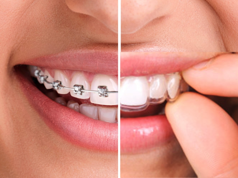 Ortodoncia invisible invisalign Terrassa Dentista